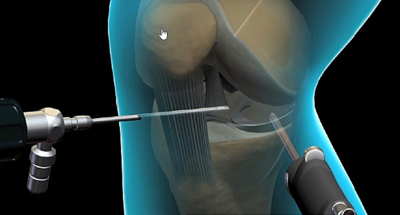 pain-after-knee-arthroscopy